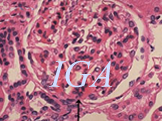 IgA Nephropathy